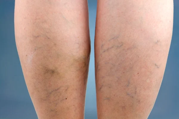 Visible spider veins, indicative of venous disease, on human legs against a blue background.