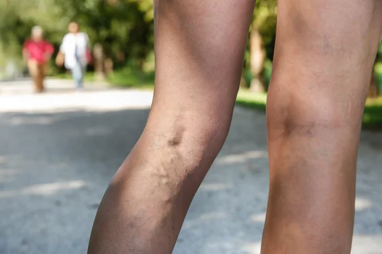 A woman with varicose veins