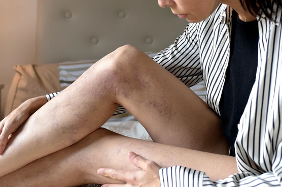 A woman sitting on a bed, closely examining bruising on her legs, suspecting it might be linked to Venous Disease.