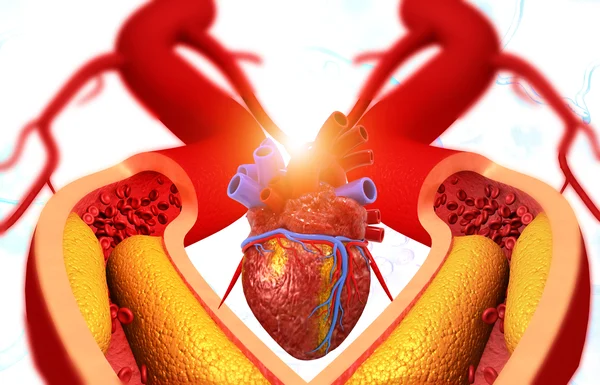 An animated image of clogged arteries