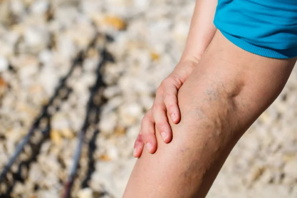 A person holding their slightly bruised knee, indicative of a venous disease, against a backdrop of pebbles.