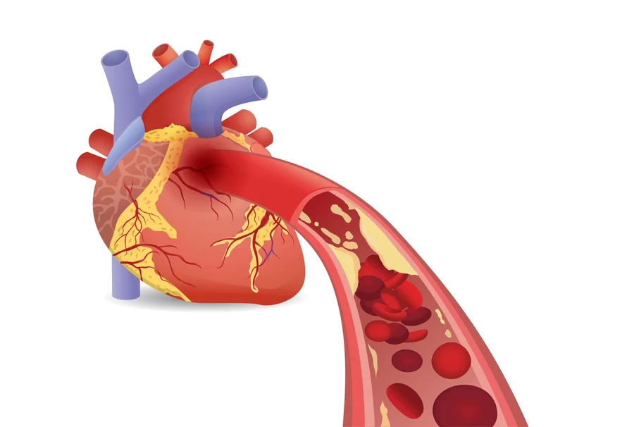 Illustration of a human heart focusing on Heart Health, with an emphasis on the coronary arteries and a cross-sectional view of a clogged artery.