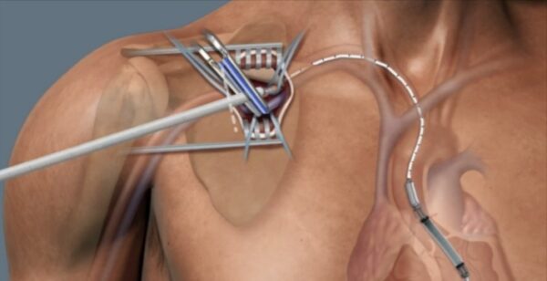 A diagram showing an Impella Device Implant point near a patient's shoulder