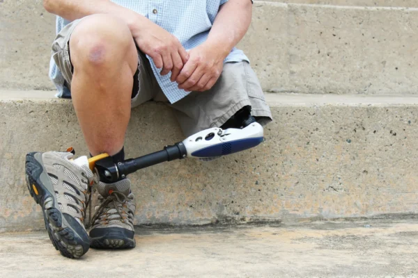 A person sitting on concrete steps, showcasing a prosthetic leg, symbolizing resilience and the advancement of prosthetic technology, under the care of specialists from the Cardiovascular Institute of the South dedicated to holistic