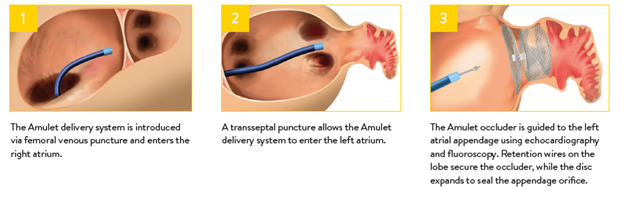A series of three medical illustrations created by the Cardiovascular Institute of the South demonstrating the process of inserting the amulet device through a transseptal puncture to close the left atrial appendage