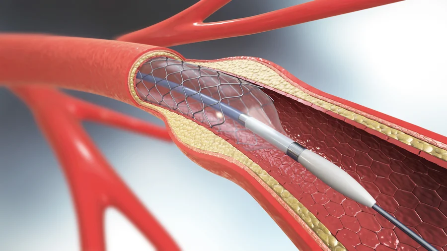 3d illustration of a stent being deployed in a narrowed blood vessel to restore flow, highlighting aspects of cardiology.