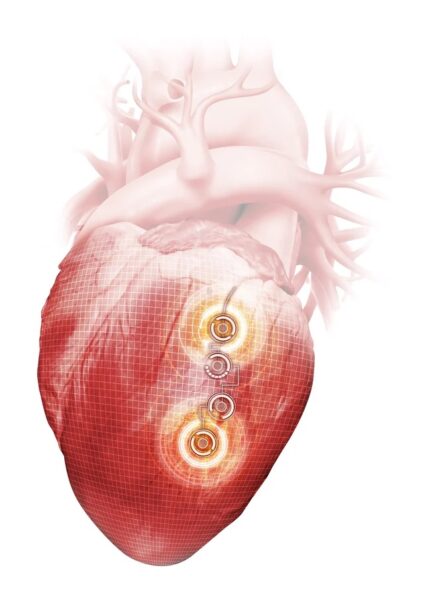 An illustrated human heart with a highlighted area showcasing a cardiac device, possibly representing a pacemaker or an internal defibrillator, with concentric circles indicating its operational zone or connectivity. This depiction is provided