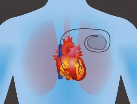 Illustration of a human chest with an implantable pacemaker connected to the heart, emphasizing heart health.