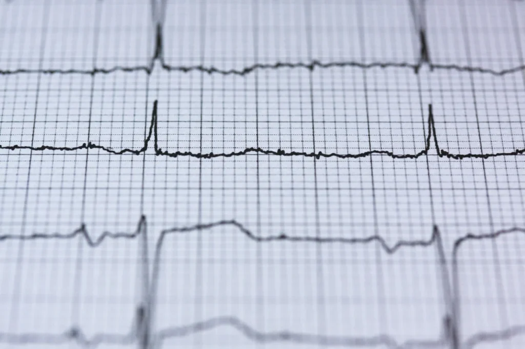 Close-up of an electrocardiogram (ekg/ecg) printout showing heart rhythm by a Cardiologist.