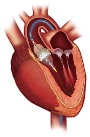 An anatomical illustration of a human heart sectioned longitudinally to show the interior chambers, valves, and blood flow pathways related to cardiology.