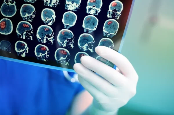 A healthcare professional examines a series of ct brain scans, possibly looking for abnormalities or assessing a patient's condition related to venous disease.