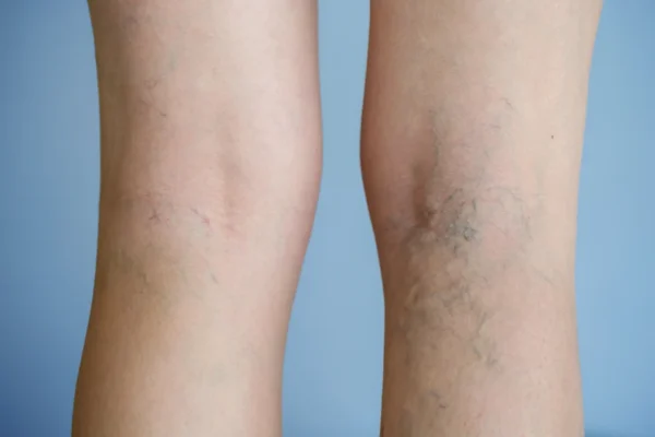 Visible varicose veins, indicative of venous disease, on a person's legs against a blue background.