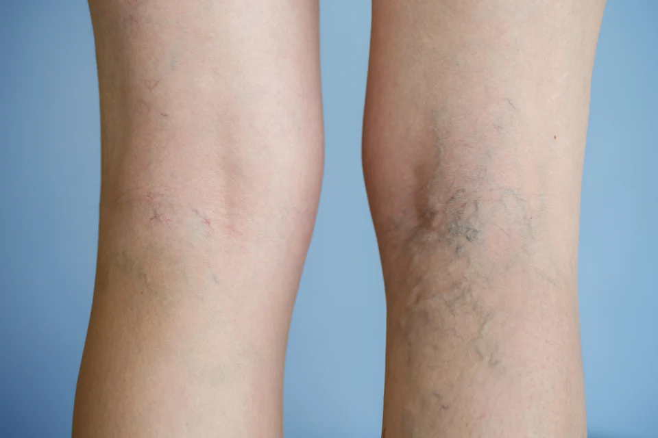 Visible varicose veins, indicative of venous disease, on a person's legs against a blue background.