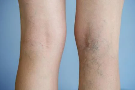 Close-up view of a person's knees showing signs of joint conditions such as possibly arthritis, dermatological issues, or concerns requiring cardiology consultation.