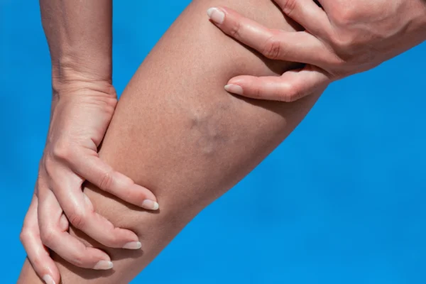 A person examining a bruise on the leg against a blue background, consulting a heart doctor for potential cardiovascular implications.