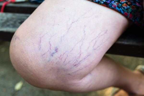 Detail of varicose veins on the leg of a seated woman.