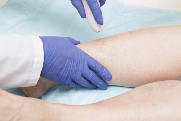 Specialist doctor conducts endovenous laser coagulation of the veins of a patient's legs