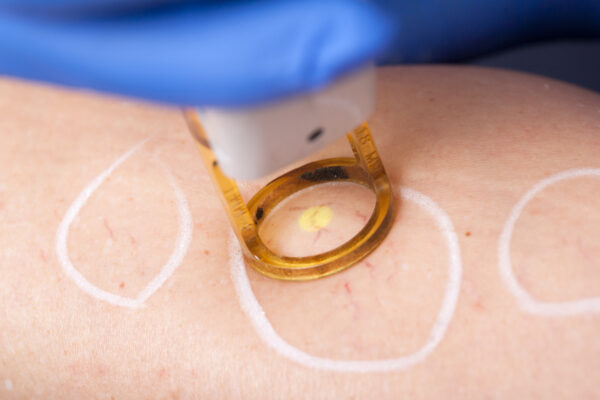 A close shot of a medical laser removing spider veins in the leg