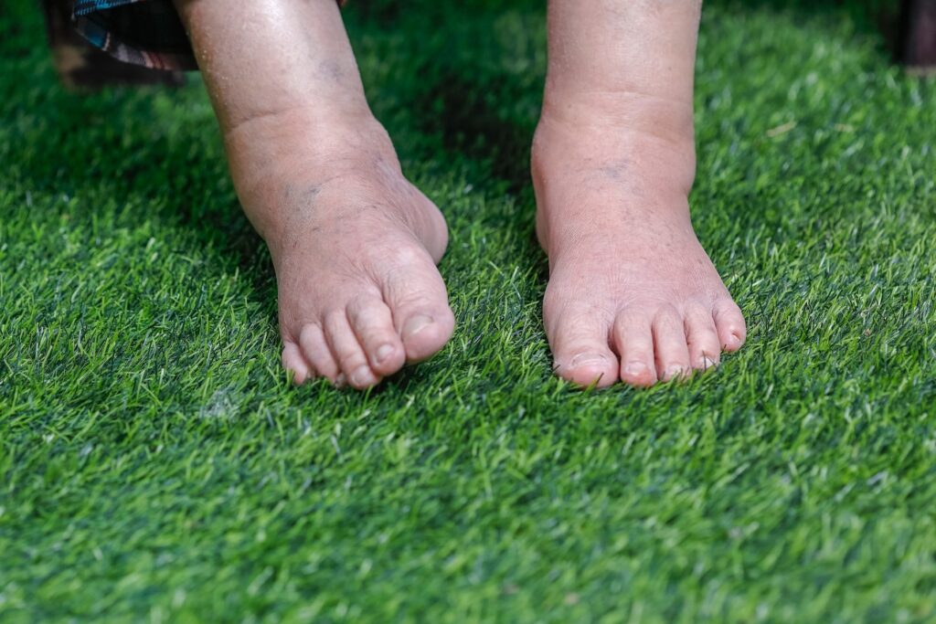 Elderly woman with bare swollen feet on grass