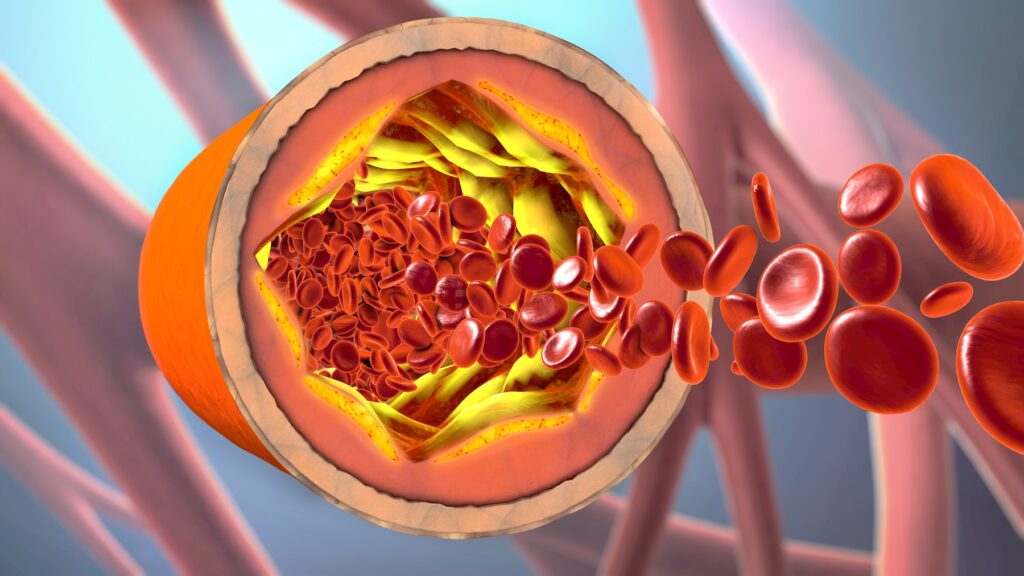 3d illustration of a precipitated and narrowing blood vessels or arteriosclerosis
